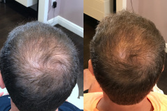 PRF-hair-restoration_1-treatment_35992