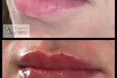 lip-filler_treatments_15795