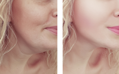 How Long Does Kybella Last?