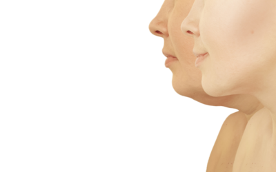 Is Kybella a Permanent Fix?