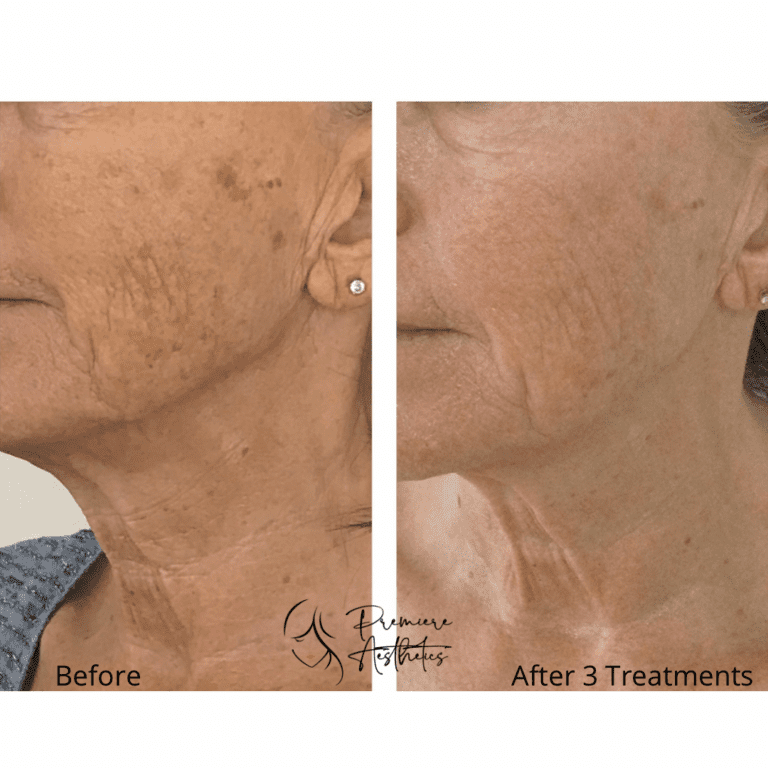 RF Microneedling in Fort Myers, FL Premiere Aesthetics