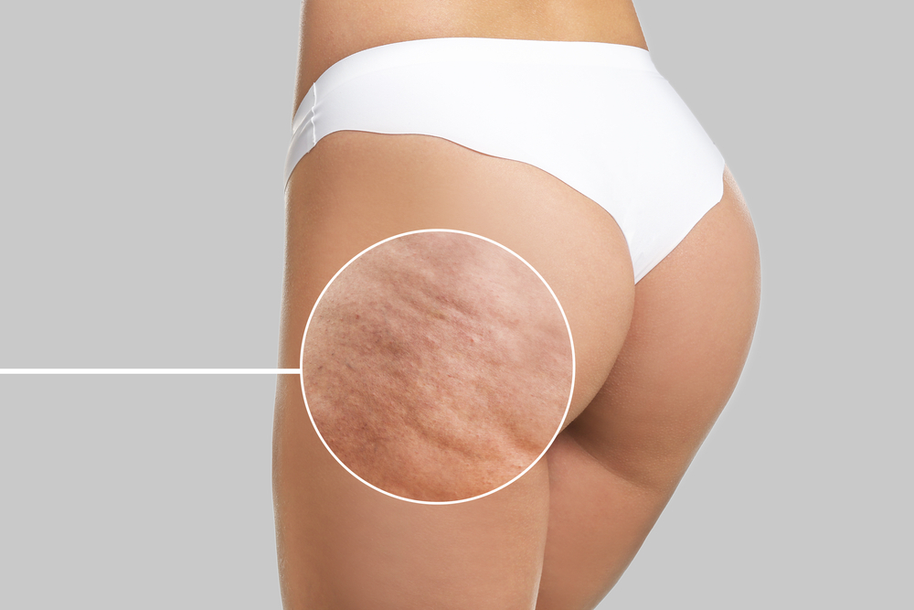 Cellulite Treatment in Fort Myers, FL