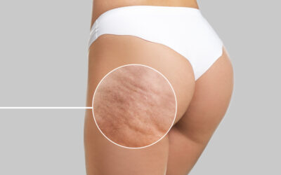 Cellulite: Understanding the Causes and Treatments