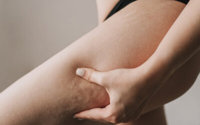 Battling Cellulite: A Comprehensive Guide to Prevention and Treatment