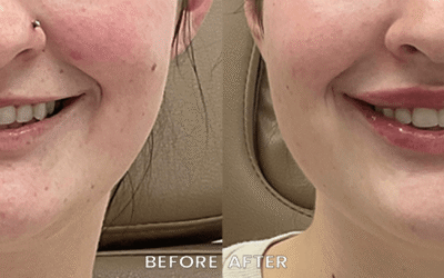 Lip Filler 1