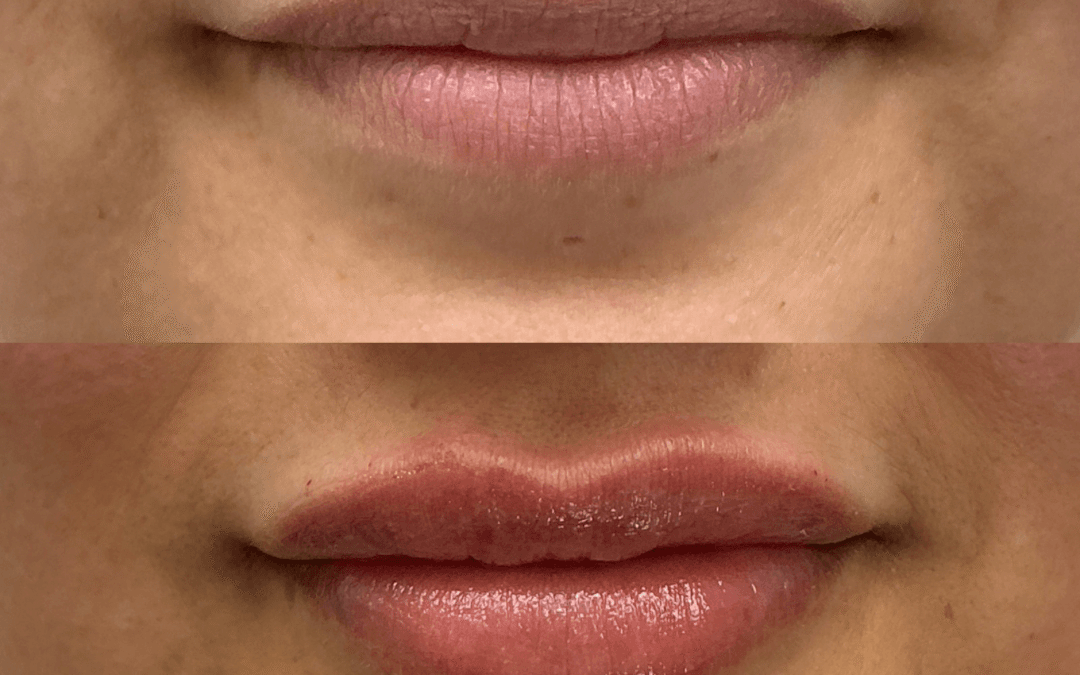 Lip Filler 2