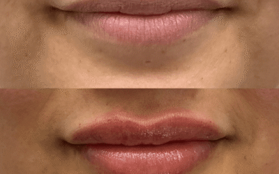Lip Filler 2