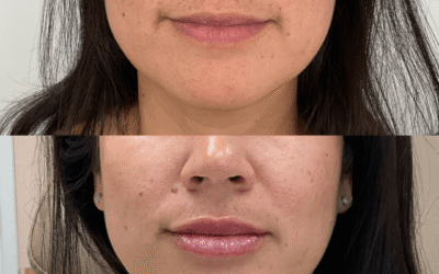 Lip Filler 3